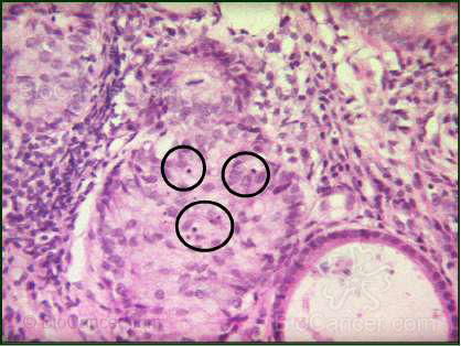 Principios generales del cáncer › Proliferación tumoral › 1. Cinética Celular. Así, en laminillas diagnósticas, teñidas con hematoxilina eosina, puede realizarse el recuento de mitosis y células apoptóticas, lo que permitirá información aproximada de acerca de estos fenómenos en un paciente concreto