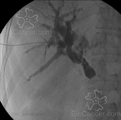 Opacificación de la vía biliar mediante punción transparieto-hepática que evidéncia obstrucción en colédoco pancreaticoy consiguiente dilatación de la vía biliar proximal a la obstrucción