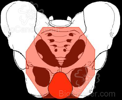 Principios generales del cáncer › Cáncer de endometrio › 9. Tratamiento. Generalidades Con intención radical 