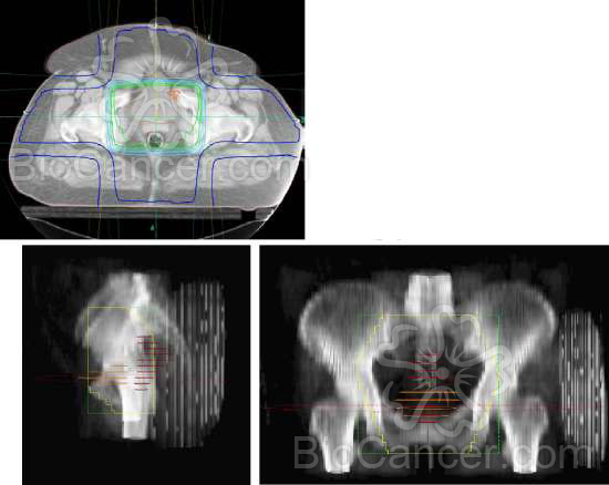 Principios generales del cáncer › Cáncer de endometrio › 9. Tratamiento. Dosimetría