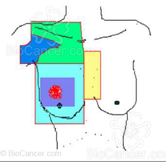 Campos de radioterapia. 50 GY en enfermedad