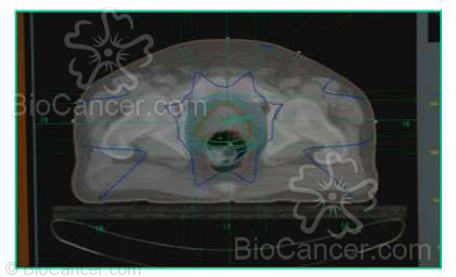 Técnica de irradiación con ocho campos, anterior, posterior, lateral derecho y lateral izquierdo y cuatro oblicuos (inferior)