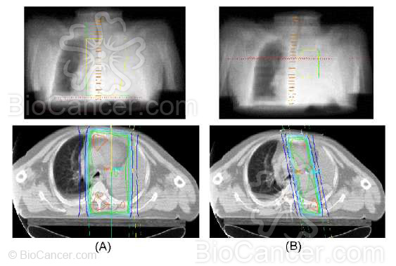 Tratamiento con radioterapia de un cáncer de pulmón estadio III A