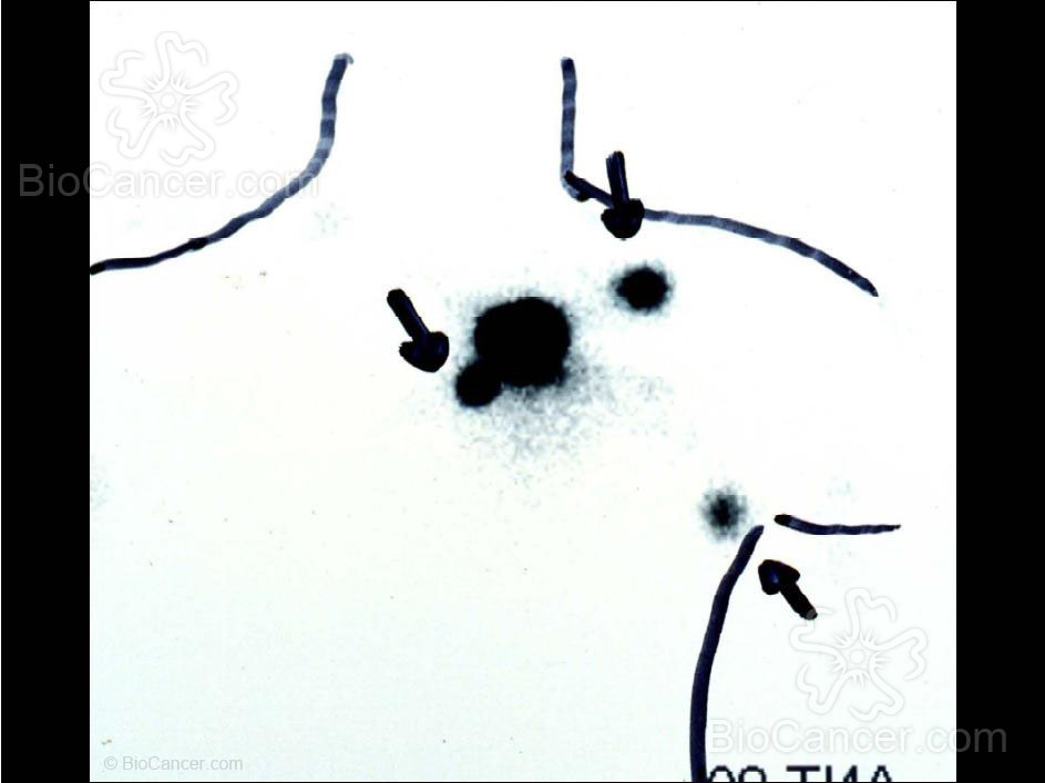 Principios generales del cáncer Tratamiento quirúrgico de los tumores y sus complicaciones Galeria De Imagenes