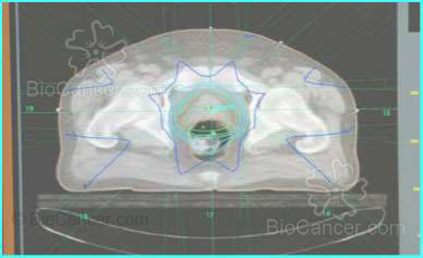 Principios generales del cáncer  Generalidades en oncología radioterápica (II) Etapas Del Proceso Radioterápico Planificación, Dosimetría Y Elección Del Equipo