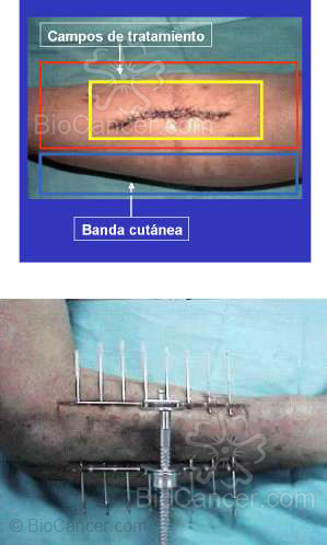 Principios generales del cáncer Sarcomas óseos y de partes blandas Sarcomas De Partes Blandas Radioterapia Radical