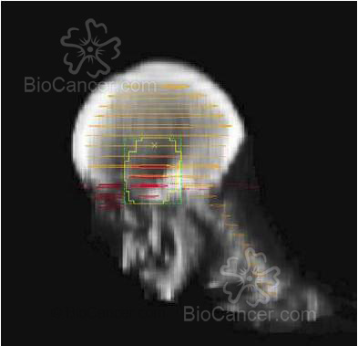 Imagen sagital a partir de cortes de TAC donde se puede ver la reconstrucción del volumen blanco de un tumor hipofisario (rojo claro) con las multiláminas que conforman el campo de irradiación (amarillo) con 1-1.5 cm de margen alrededor del volumen blanco