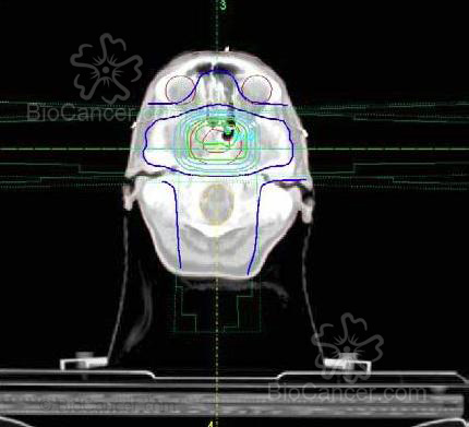 Imagen de un corte axial del TAC de dosimetría donde se aprecia las distintas isodosis de distribución de la radiación sobre el cerebro: rojo interior = volumen tumoral; rojo exterior = margen de +/- 1.5 cm; verde interior = isodosis del 100%; verde exterior = isodosis del 95%; azul  clara interior = isodosis del 90%