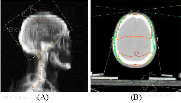 Tratamiento con radioterapia sobre volumen holocraneal. (A) Reconstrucción radiográfica digital. (B) Curvas de isodosis