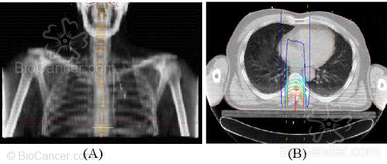 Tratamiento con radioterapia de una compresión medular. (A) Reconstrucción radiográfica digital. (B) Curvas de isodosis