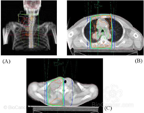Tratamiento con radioterapia de un síndrome de vena cava superior. (A) Reconstrucción radiográfica digital. (B) Curvas de isodosis a nivel de mediastino. (C) Curvas de isodosis a nivel supraclavicular