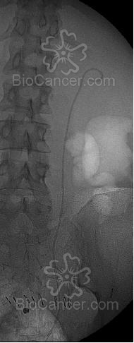 Endoprótesis ureteral que se extiende desde la pelvis renal a la vejiga