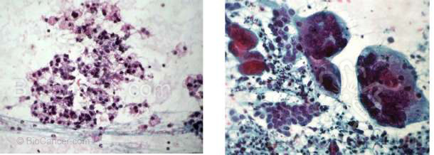 Ejemplo de dos neoplasias suprarrenales (citología por punción con aguja fina), una bien diferenciada (izqda.) y otra muy anaplásica con un pleomorfismo extremo (dcha.)